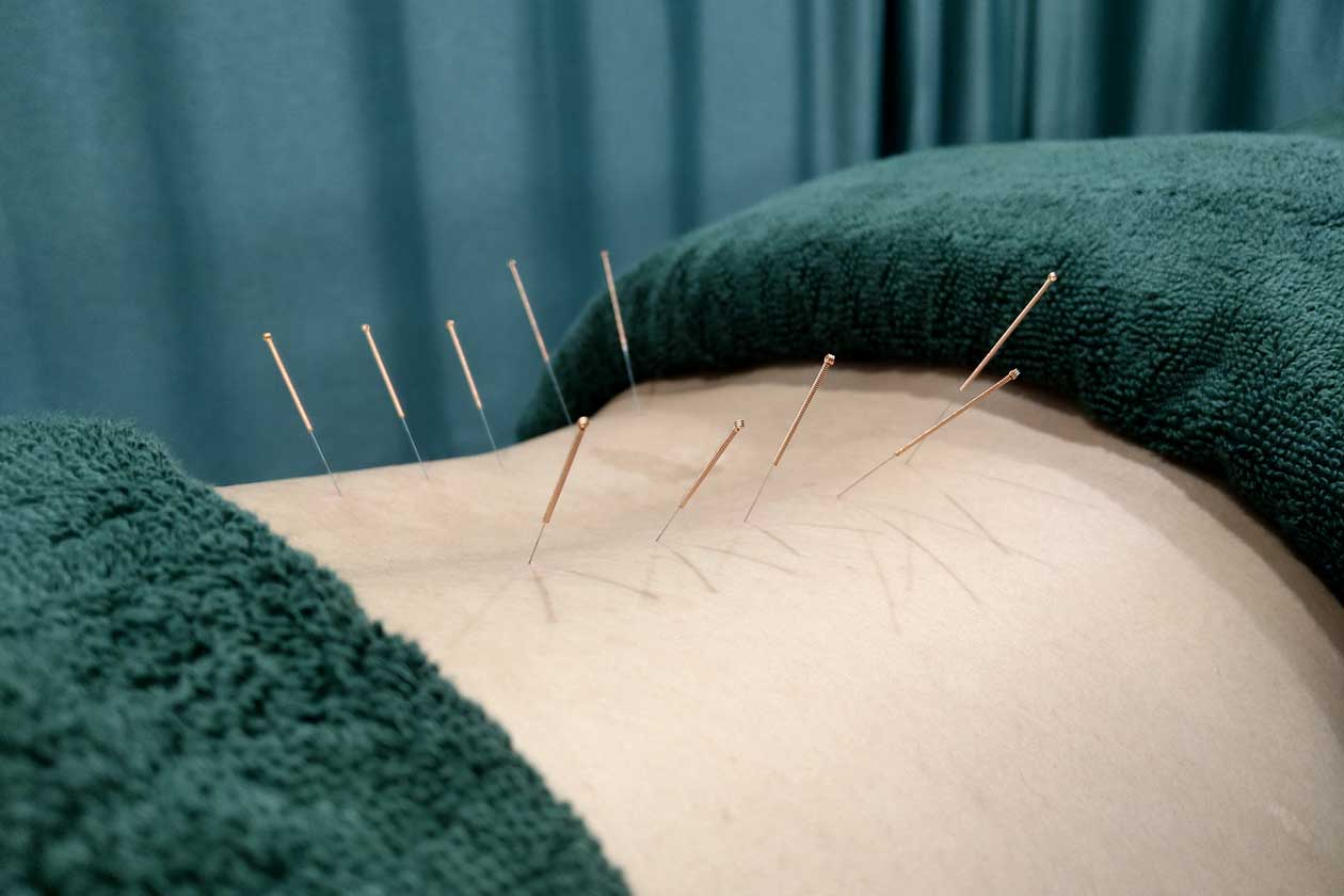 Living-Chi-Acupuncture-Treatment