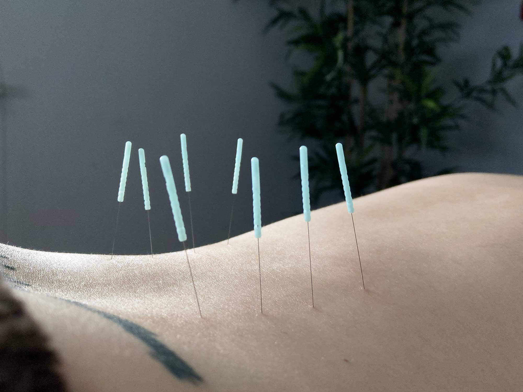 Acupuncture - Living Chi