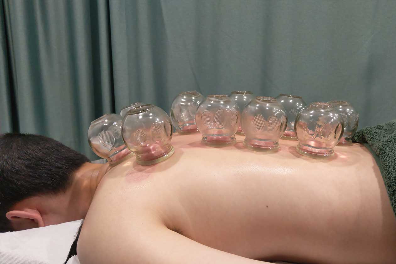 Living-Chi-Fire-Cupping-Treatment