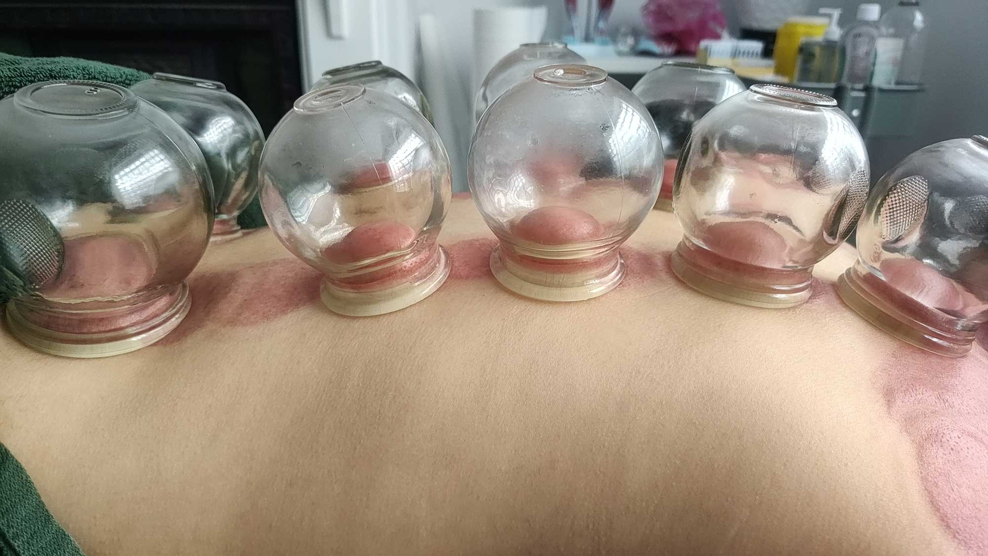 Living-Chi-Fire-Cupping-Technique-Suction-Treatment